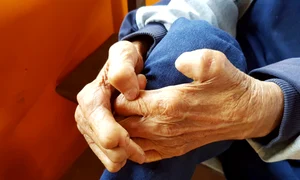Mâinile unei femei afectate de lepră FOTO Shutterstock
