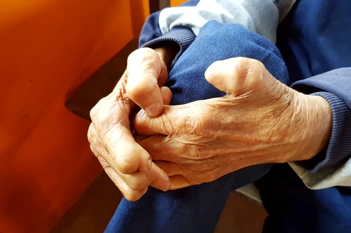 Primul caz de lepră în România după 44 de ani, confirmat la Cluj / foto: Shutterstock