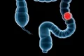 1 cancer colon jpg jpeg