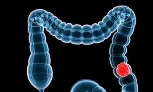 1 cancer colon jpg jpeg