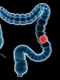 1 cancer colon jpg jpeg