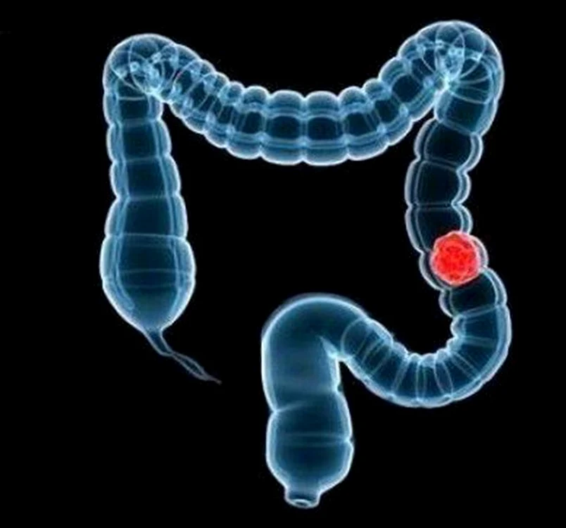 1 cancer colon jpg jpeg