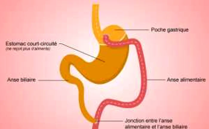 Bypass-ul gastric este o operaţie care are drept rezultat reducerea sensibilă în greutate