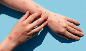 variola maimutei tw1 png