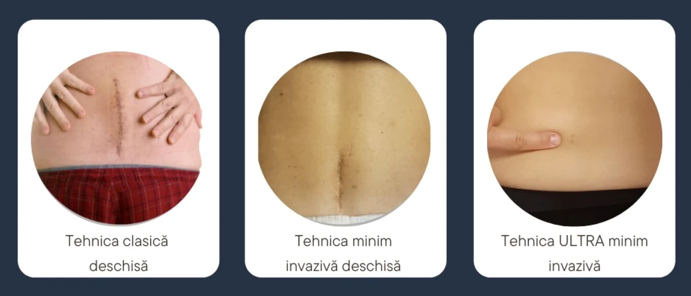 Dr. Ştefan Mindea - neurochirurgul venit de la Stanford la Constanţa - care a inventat tehnica ultra minim invazivă la nivel lombar şi cervical Sursa mindea.ro