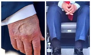 boala trump jpg