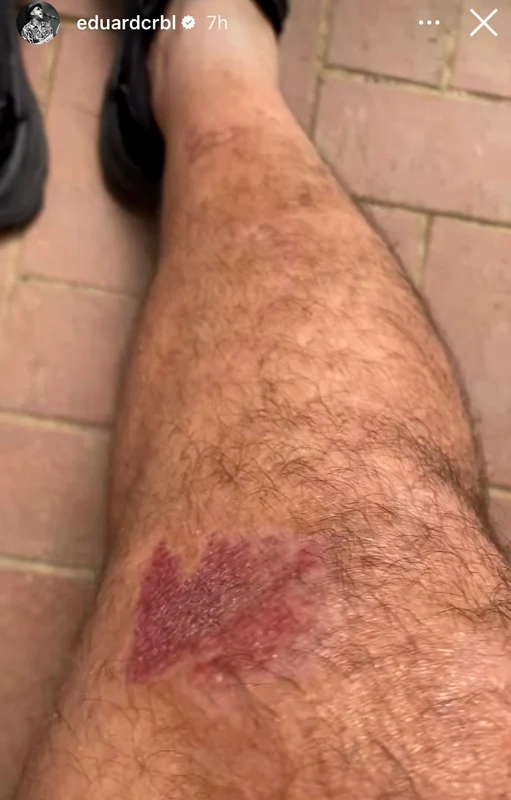 CRBL, plin de răni după accident  