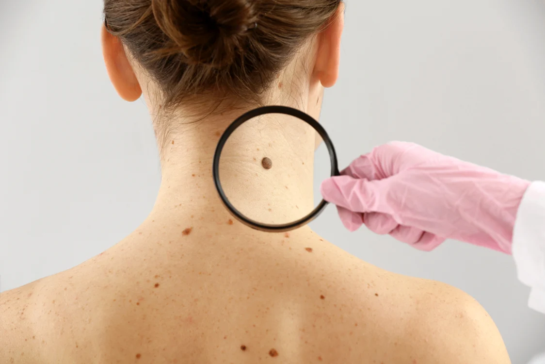 Alunițe roșii sau de culoarea cărnii pot fi un semn al cancerului de piele. Foto: Click.