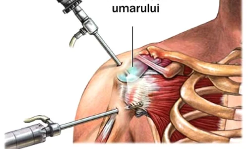 Artroscopia de umăr se face fie sub anestezie generală, fie sub anestezie loco regională jpeg