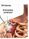Artroscopia de umăr se face fie sub anestezie generală, fie sub anestezie loco regională jpeg