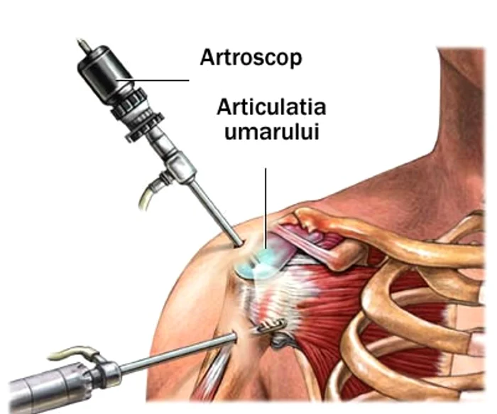 Artroscopia de umăr se face fie sub anestezie generală, fie sub anestezie loco-regională