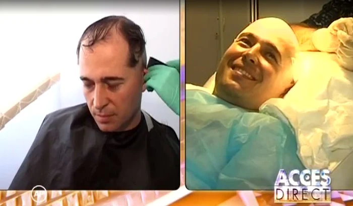 Dinu Maxer şi-a făcut implant de păr