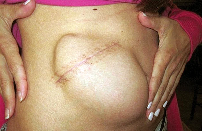 Sfertul de craniu i-a fost introdus în abdomen ca să rămână steril