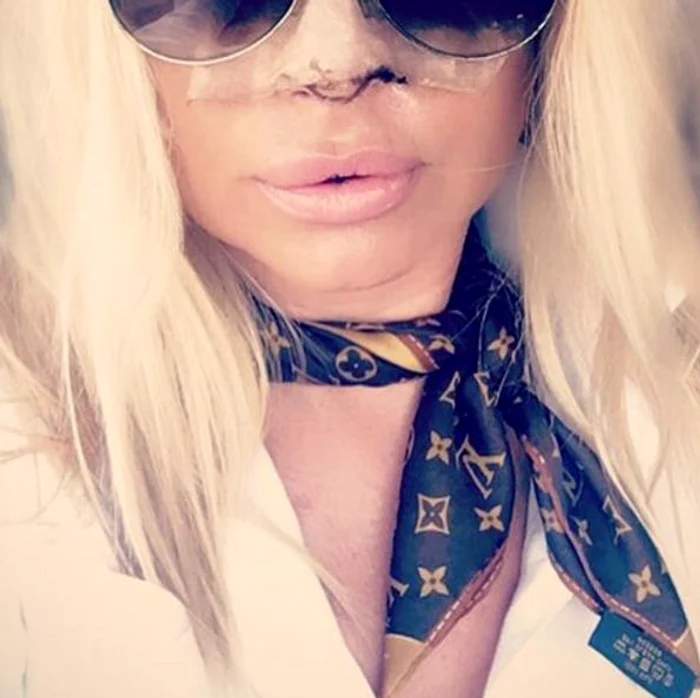 Vica Blochina a publicat o poză cu noul nas