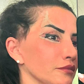 Mara Bănică a suferit o blefaroplastie inferioară foto Instagram 