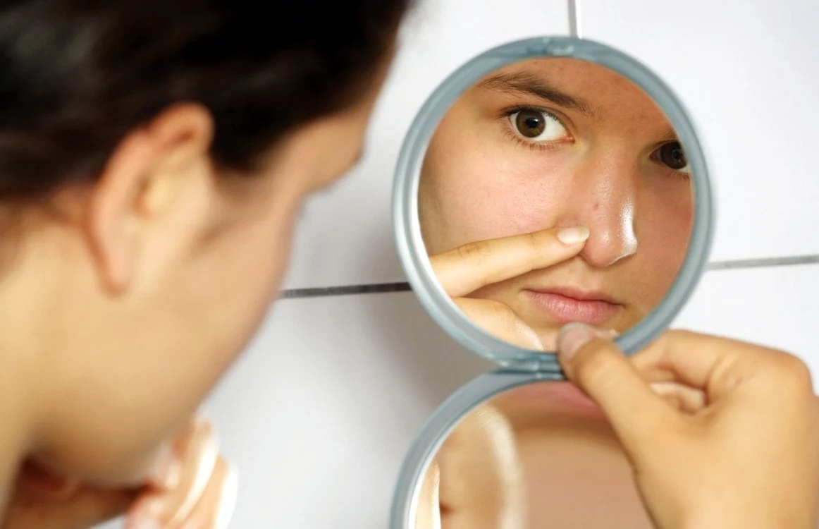 Chisturile sebacee au forma unor umflături sub piele FOTO Fotolia