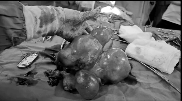 Tumora extirpată de la femeia de 75 de ani FOTO spital Buhuși
