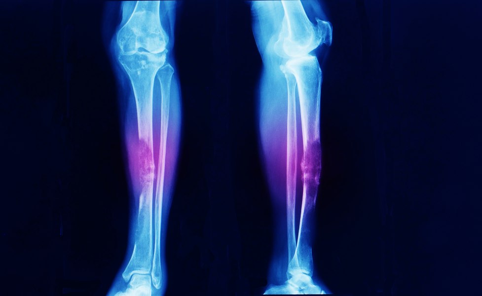 O substanță injectabilă gelatinoasă, soluție pentru vindecarea articulațiilor fără intervenție chirurgicală. Ar putea trata inclusiv osteoartrita 