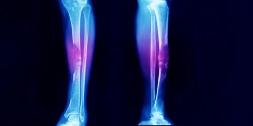 cancer_osos_shutterstock 1407575135 jpg
