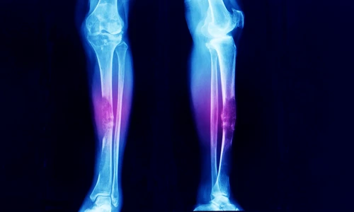 cancer_osos_shutterstock 1407575135 jpg