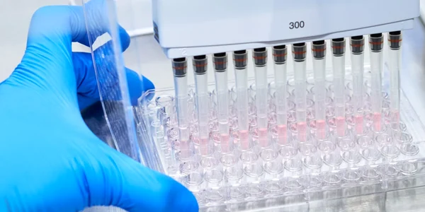 Alzheimer test sange roche jpeg