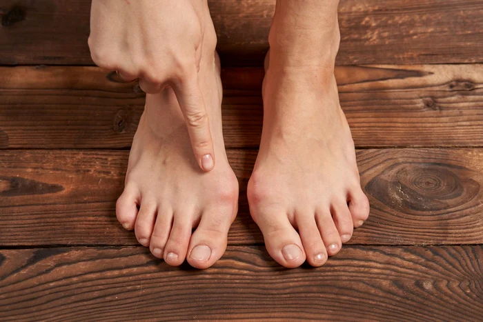 Monturile pot fi prevenite cu ajutorul unor exerciții de tonifiere a piciorului. Foto: Arhivă