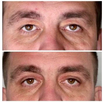 blefaroplastie iancu morad luxury 2 jpg