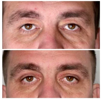 blefaroplastie iancu morad luxury 2 jpg