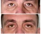 blefaroplastie iancu morad luxury 2 jpg