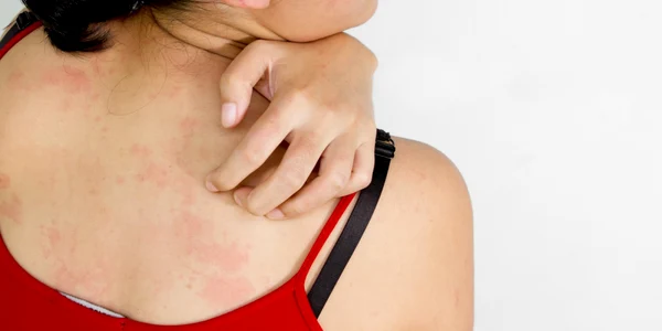 Alergie - iritatie - scarpinat - FOTO Shutterstock