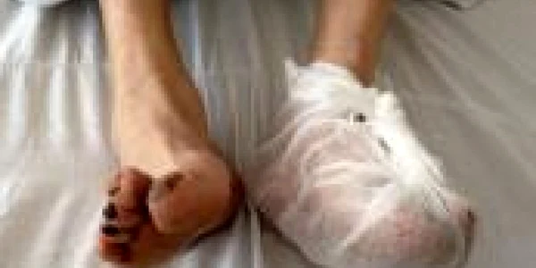 Cei doi aveau degerături la picioare de gradul trei şi patru