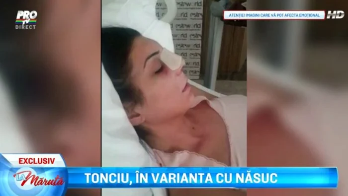 Andreea Tonciu este umflată după operaţie