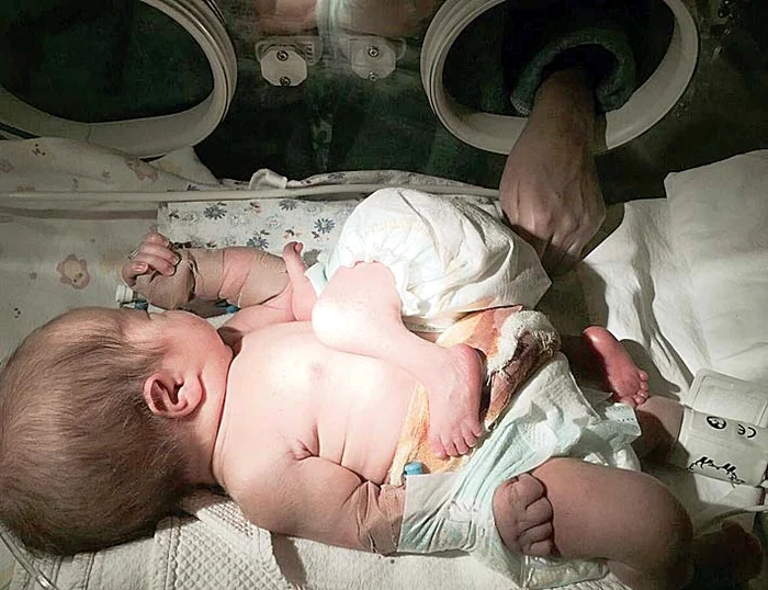 Siamezii erau lipiţi în zona abdomenului