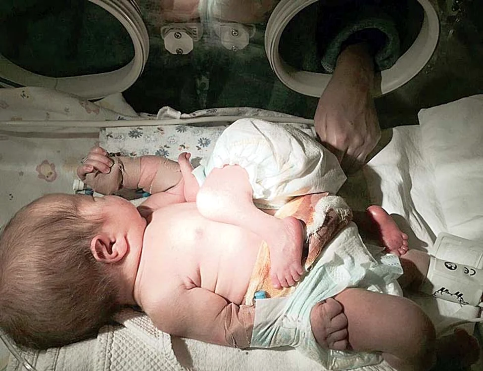 Siamezii erau lipiţi în zona abdomenului