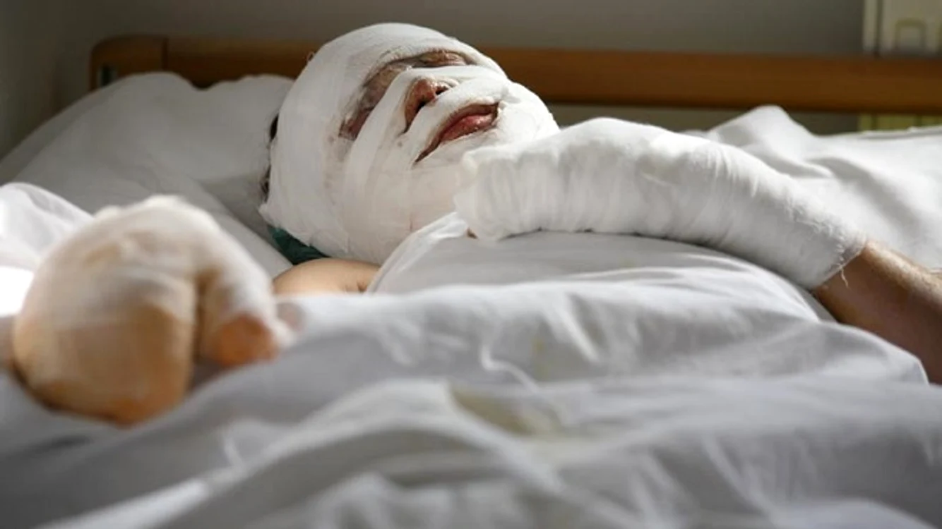
    Comisia medicală va stabili în cel mult două ore dacă pacientul ars trebuie sau nu să fie trimis la o clinică din străinătate  