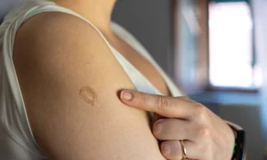 vaccin cicatrice istock jpg