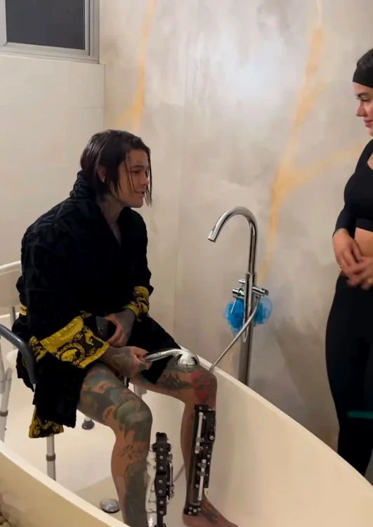 Influencerul trebuie să stea o perioadă cu tije metalice înfipte în picioare (Foto: Instagram)