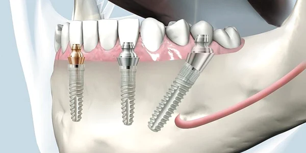 Implant dentar bredent-fast-fixed Foto dentaclinic ro