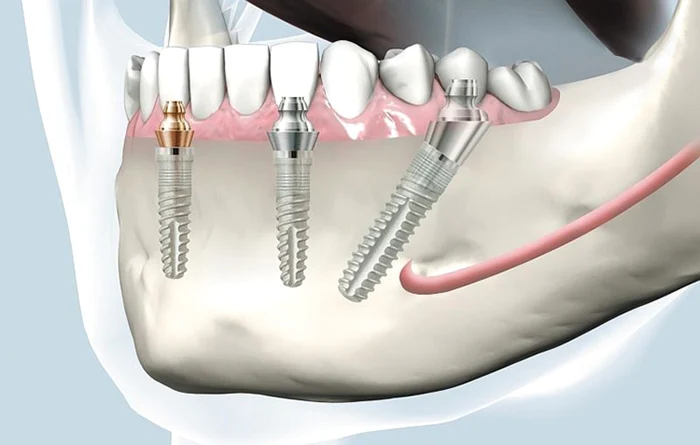 Implant dentar bredent-fast-fixed Foto dentaclinic ro