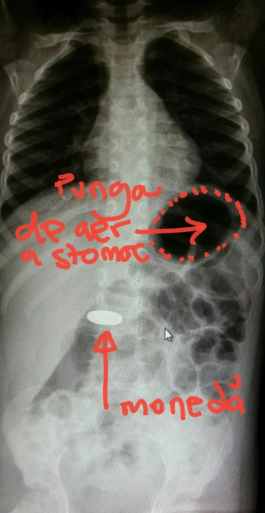 Radiografie corp străin  FOTO Facebook SVPC