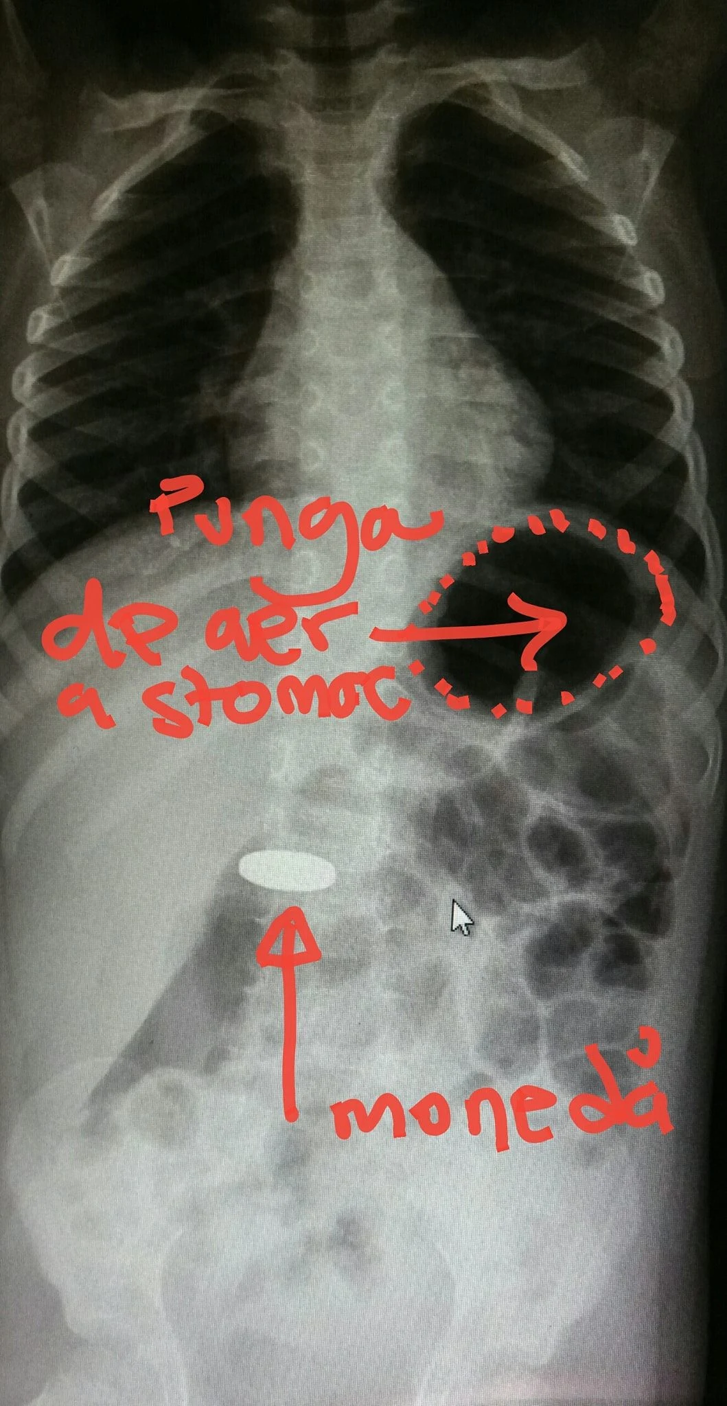 Radiografie corp străin FOTO Facebook SVPC