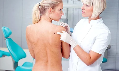pacienta medic dermatolog control cancer piele alunita jpeg