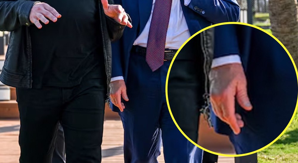 Misterul semnelor de pe mâna lui Trump. „Regina a avut o vânătaie similară cu o săptămână înainte să moară”. Casa Albă oferă explicații