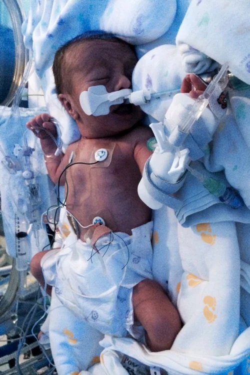 Cody cântărea doar 1,8 kilograme la naștere