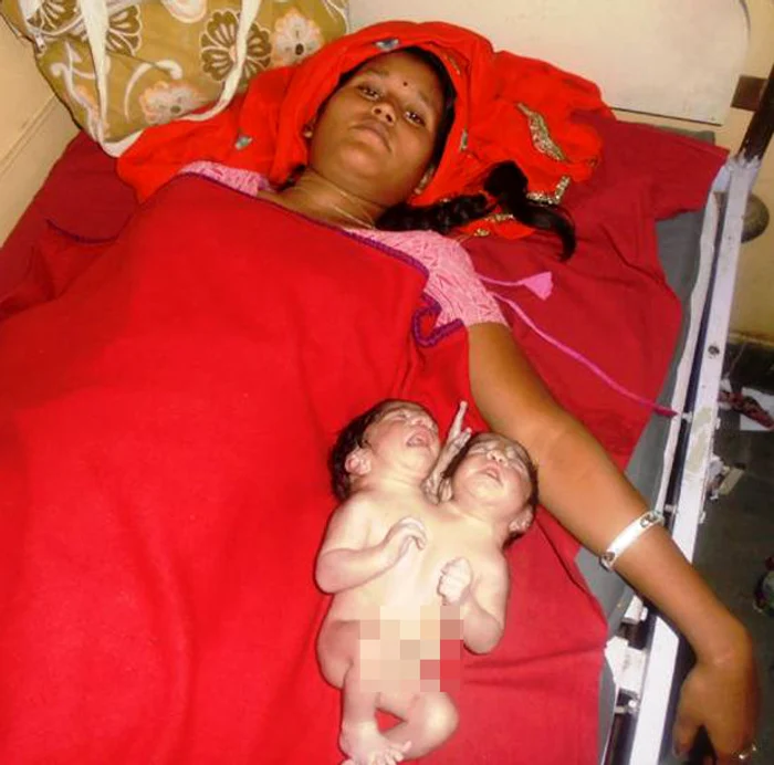 Mama şi cei doi gemeni conjuncţi, imediat după naştere
