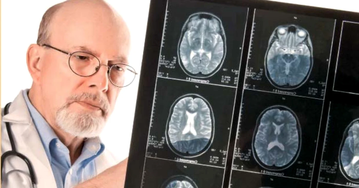 Disfuncţiile celulelor T pot da naştere bolilor autoimune şi inflamaţiilor la nivelul creierului, specifice bolii Alzheimer FOTO Shutterstock
