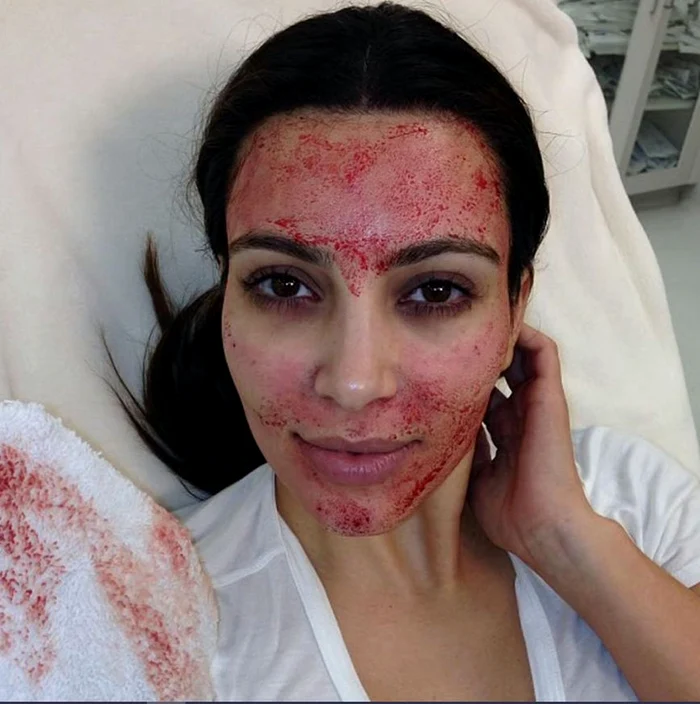 Kim Kardashian se menține tânără cu „terapia-vampir” (Foto: Instagra)