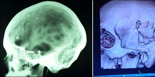 craniu petr cech Foto telegraph.co.uk