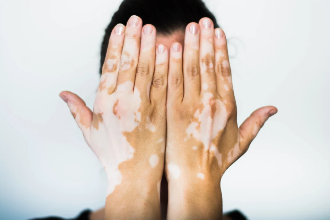 2 vitiligo jpg jpeg