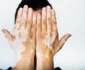 2 vitiligo jpg jpeg